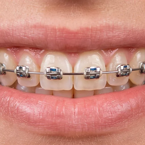 Брекеты на одну челюсть: что нужно знать