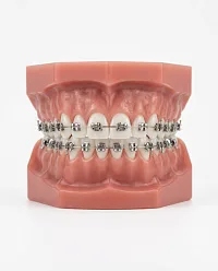 Исправление прикуса