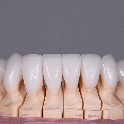 Стоит ли устанавливать виниры?