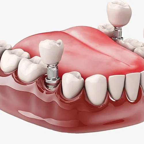 Десна после имплантации зуба