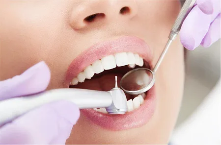 Лечение кариеса