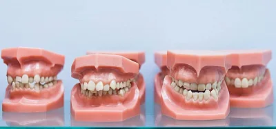 Прикус зубов правильный и неправильный: как определить?