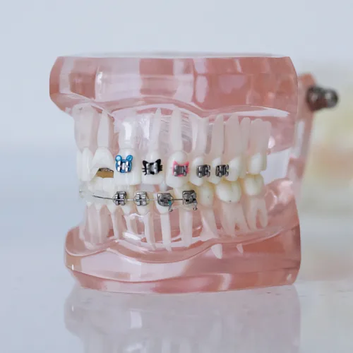 Мифы о брекетах — разбор от эксперта