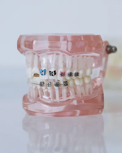 Мифы о брекетах — разбор от эксперта