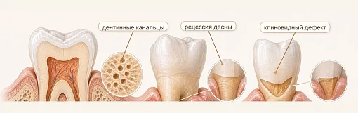Чувствительность зубов: почему появляется и как лечить