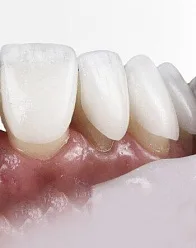 Керамические виниры