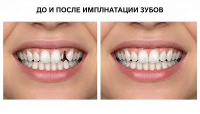 Когда съемные протезы — лучший выбор