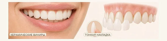 Керамические виниры в Тюмени: что это, как устанавливают и кому подходят