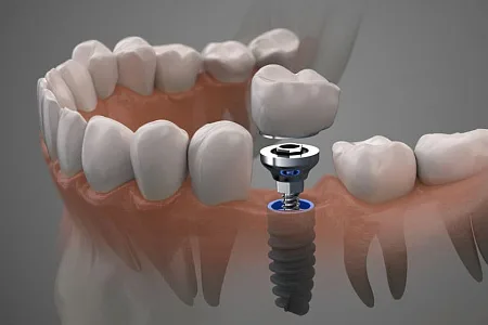 Коронка на имплант