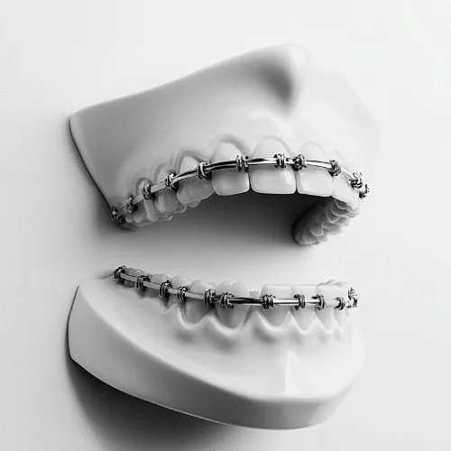 Ортодонтия для взрослых: брекеты, элайнеры, капы