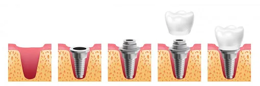 Этапы имплантации зубов