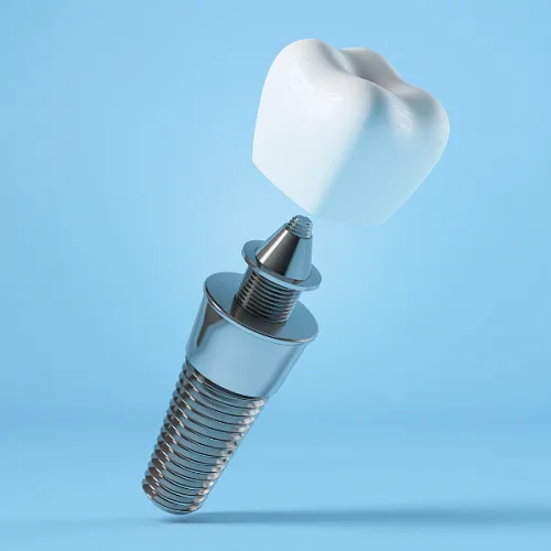 Через сколько после удаления зуба можно ставить имплант?