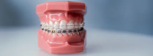 Мифы о брекетах — разбор от эксперта