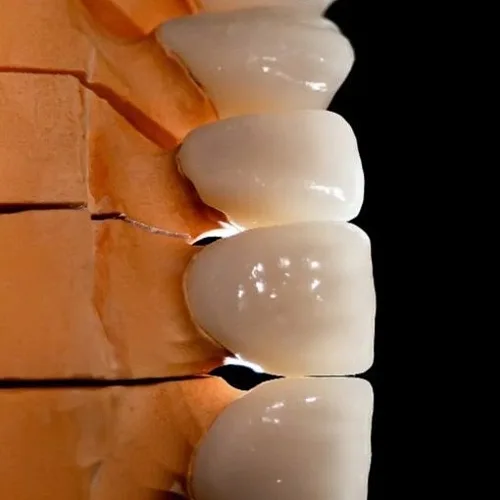 Диоксид циркония или металлокерамика – что выбрать?