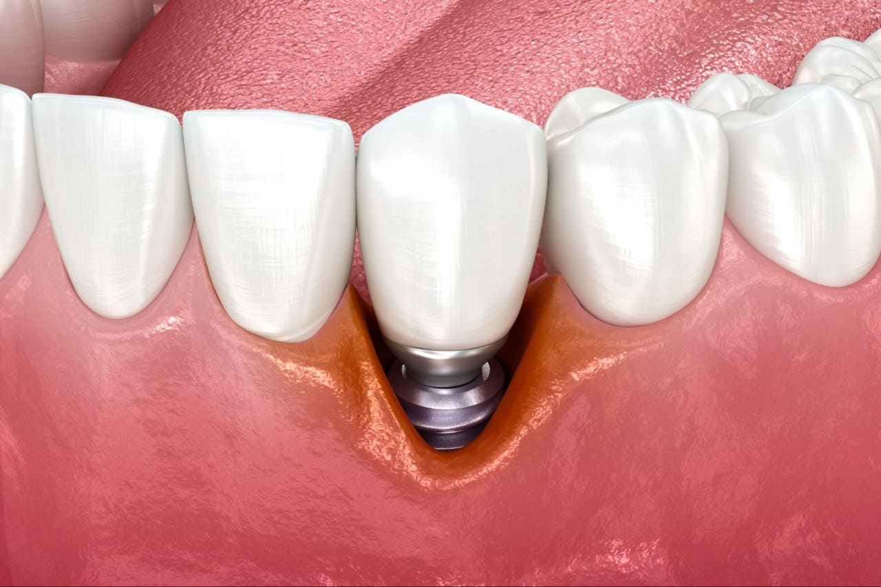 Удаление импланта зуба 