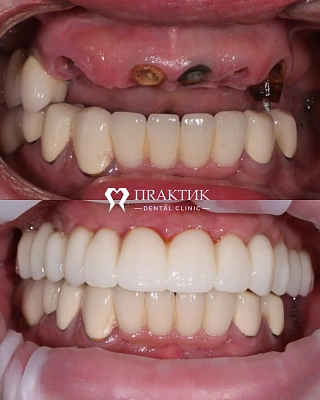«Все на 6»: как мы вернули естественную улыбку пациентке с полным отсутствием зубов на верхней челюсти