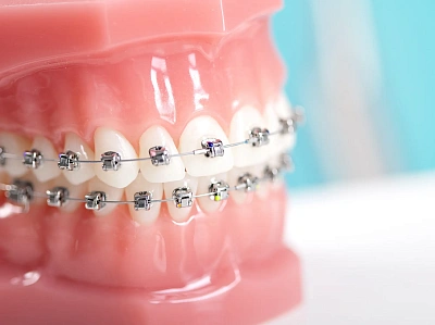 Болят зубы после установки брекетов
