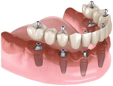 Несъемные импланты