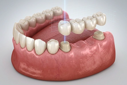 Мостовидные протезы