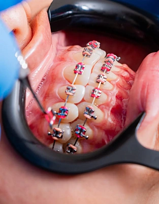 Белые пятна на зубах после снятия брекетов: причины, профилактика и коррекция