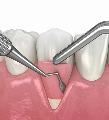 Пластика десны: возможности современной стоматологической хирургии