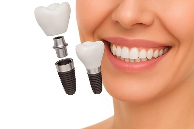 Имплант Dentium (Южная Корея) от 29 900 ₽