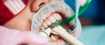 Профессиональная чистка зубов: клинически доказанная необходимость