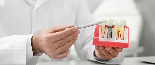 Имплантация зубов: полное руководство для пациентов. От А до Я