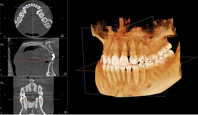 3D-снимок в подарок при имплантации зубов в Практик! Диагноз со 100% точностью, а не «на глаз».
