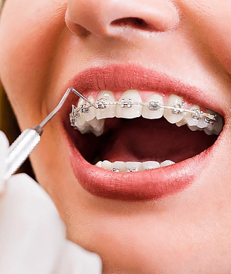 Рекомендации после установки брекетов 