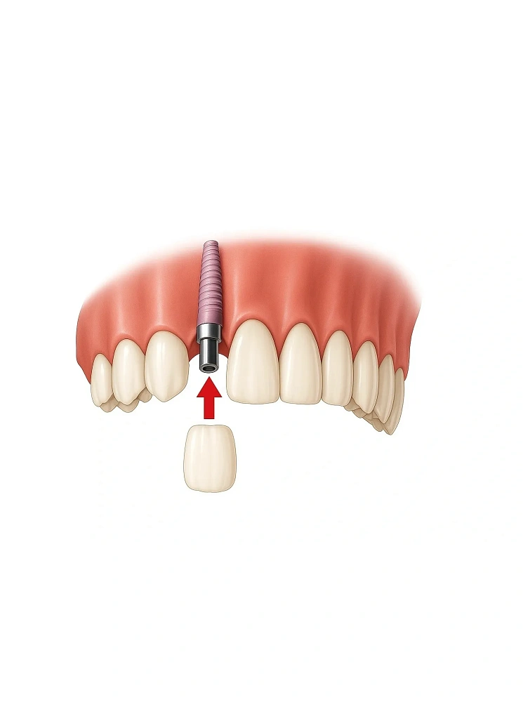Имплантация верхней челюсти
