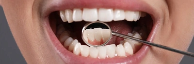 Зубной камень - как избавиться и можно ли удалить в домашних условиях?