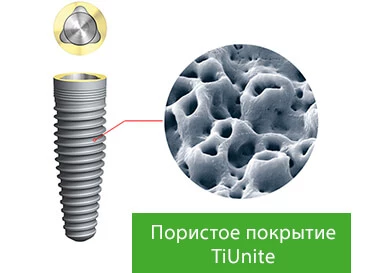 Импланты