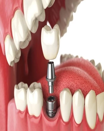 имплантация 1 зуба под ключ